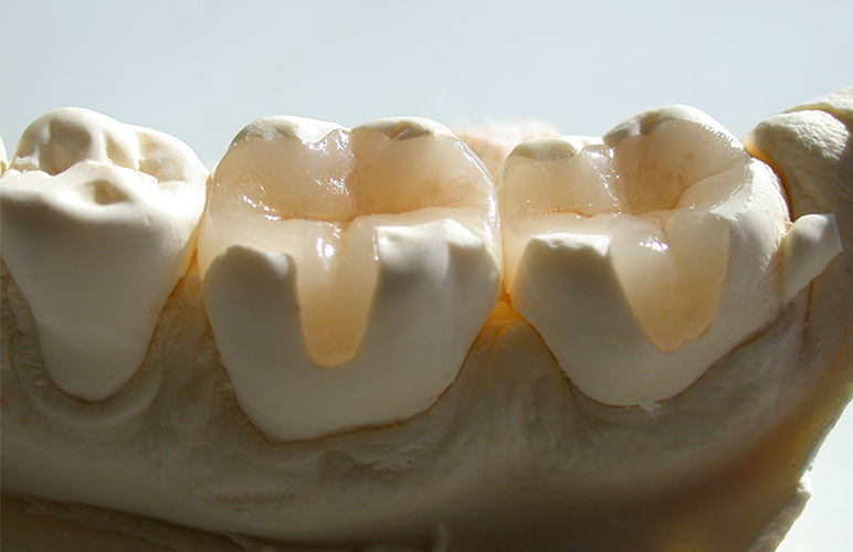 奥歯にも白い歯を適用できる