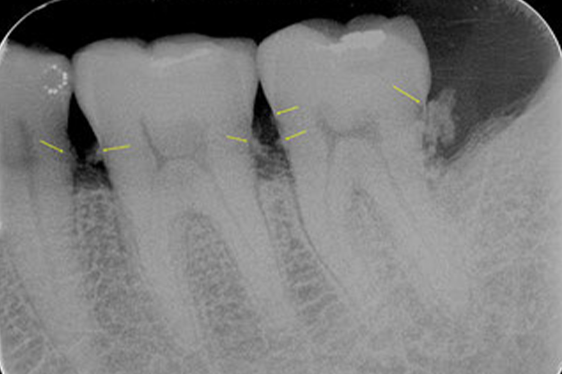 歯周病のX線診査