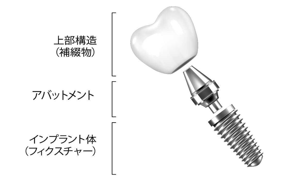 歯科用インプラントの構成