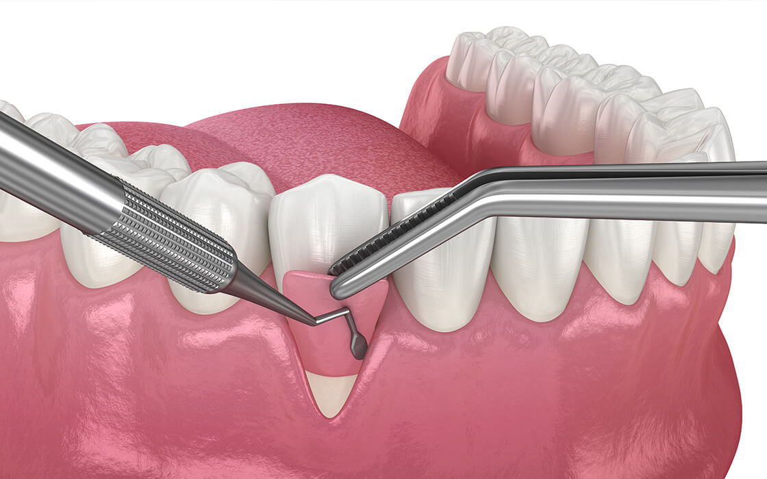 GTR法/歯周組織再生誘導療法