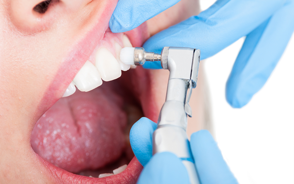 歯科衛生士によるクリーニング（PMTC）