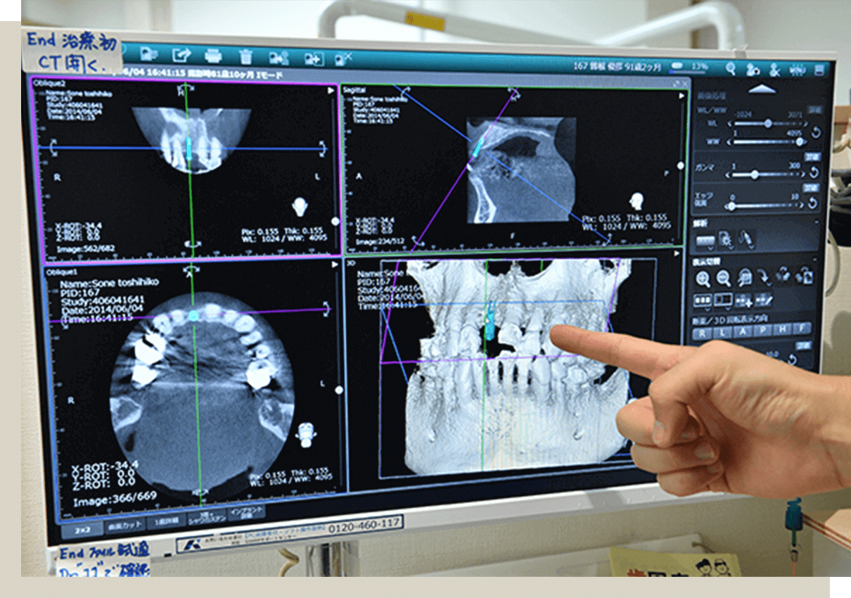 開業から25年以上 実績を重ねたインプラント埋入治療技術